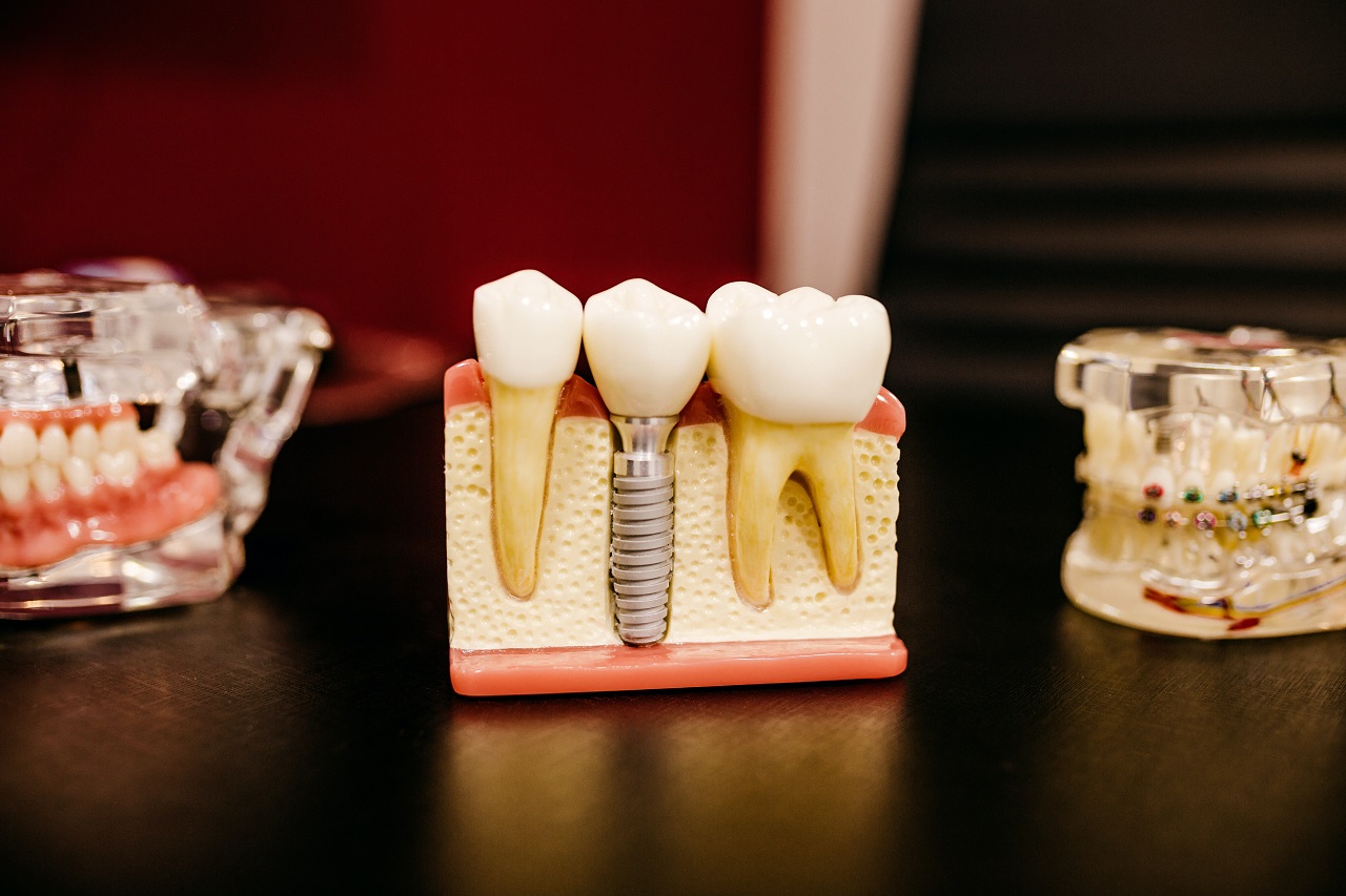 W jakiej sytuacji powinniśmy się zdecydować na implant zębowy?